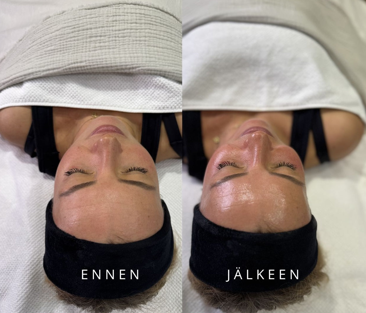 CELESTETIC Detox & Glow with Aquapeel